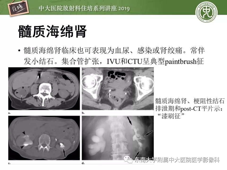 【PPT】血尿的影像分析思路