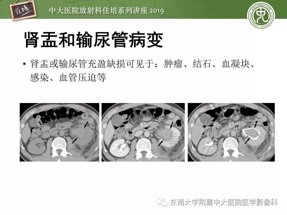 【PPT】血尿的影像分析思路