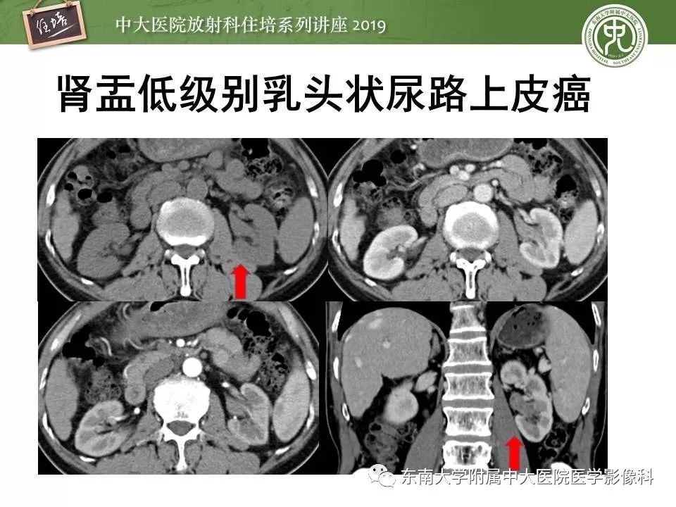 【PPT】血尿的影像分析思路
