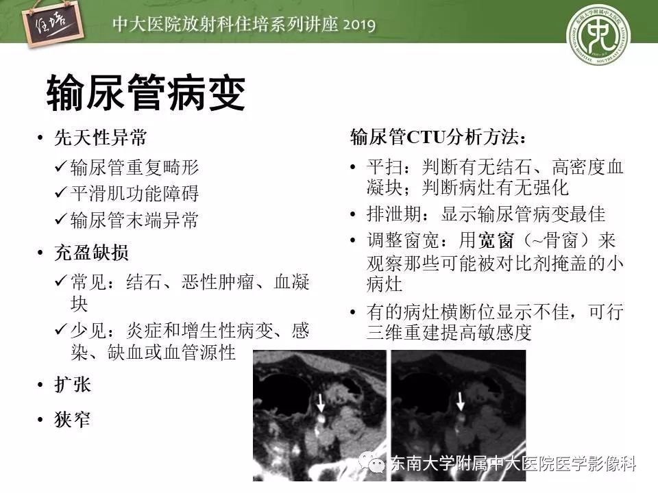 【PPT】血尿的影像分析思路