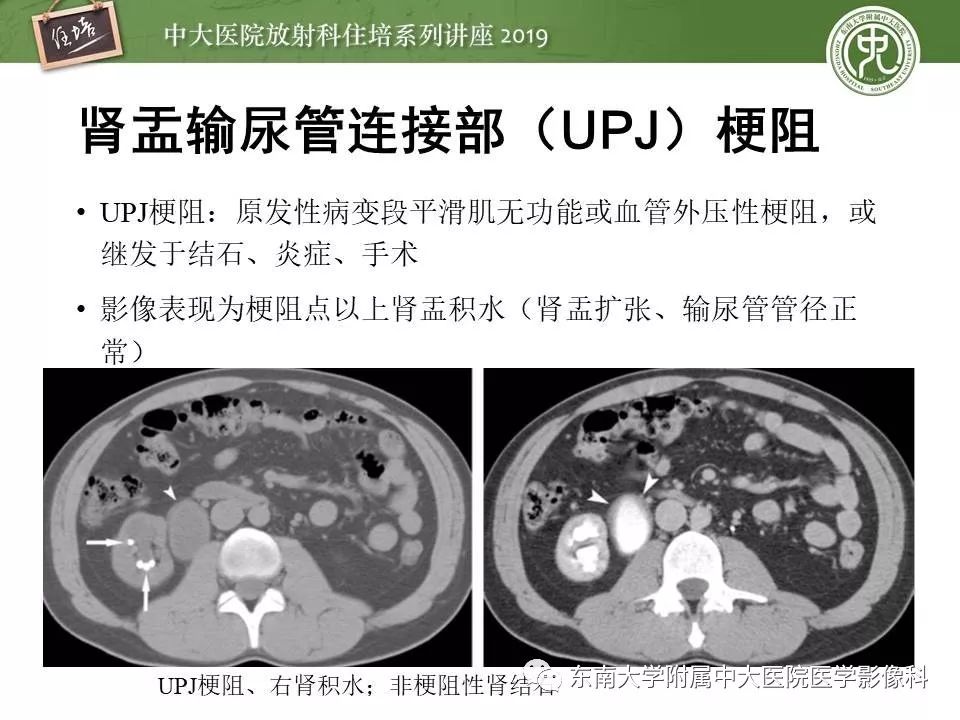 【PPT】血尿的影像分析思路