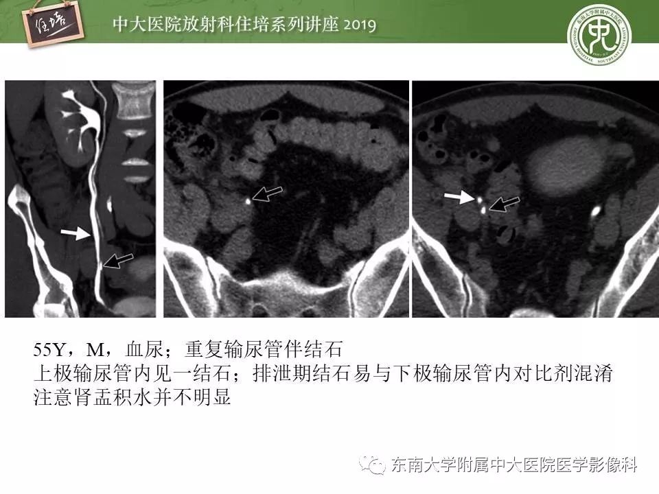 【PPT】血尿的影像分析思路