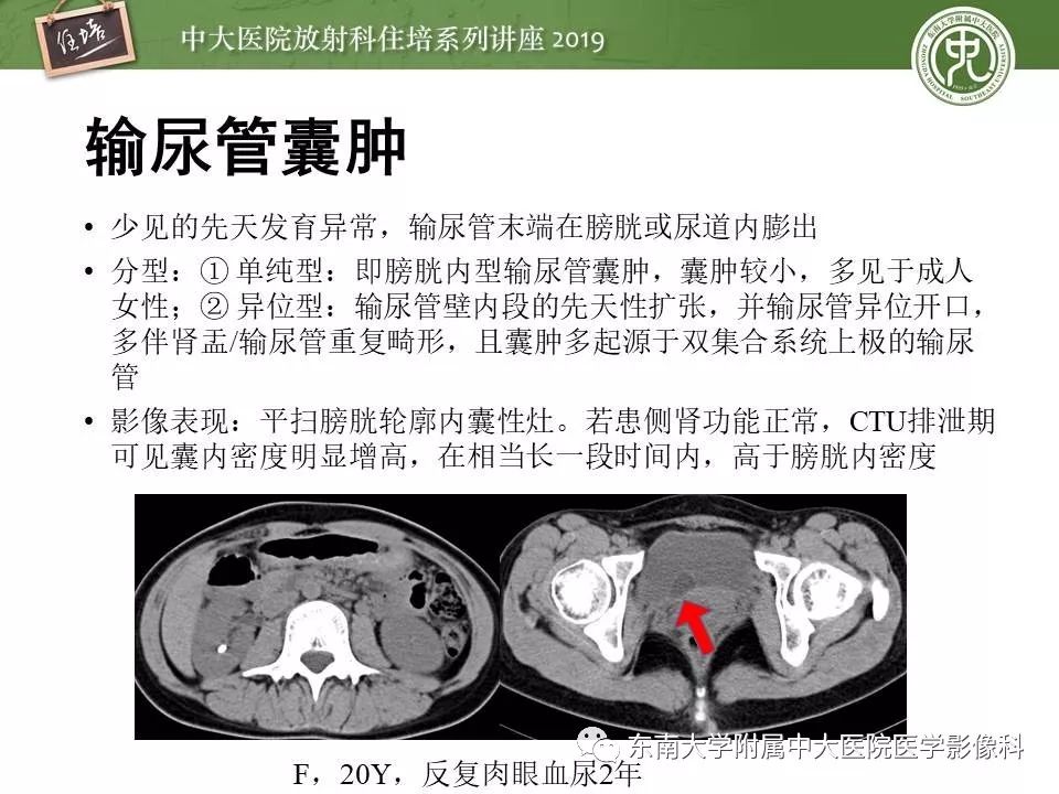 【PPT】血尿的影像分析思路