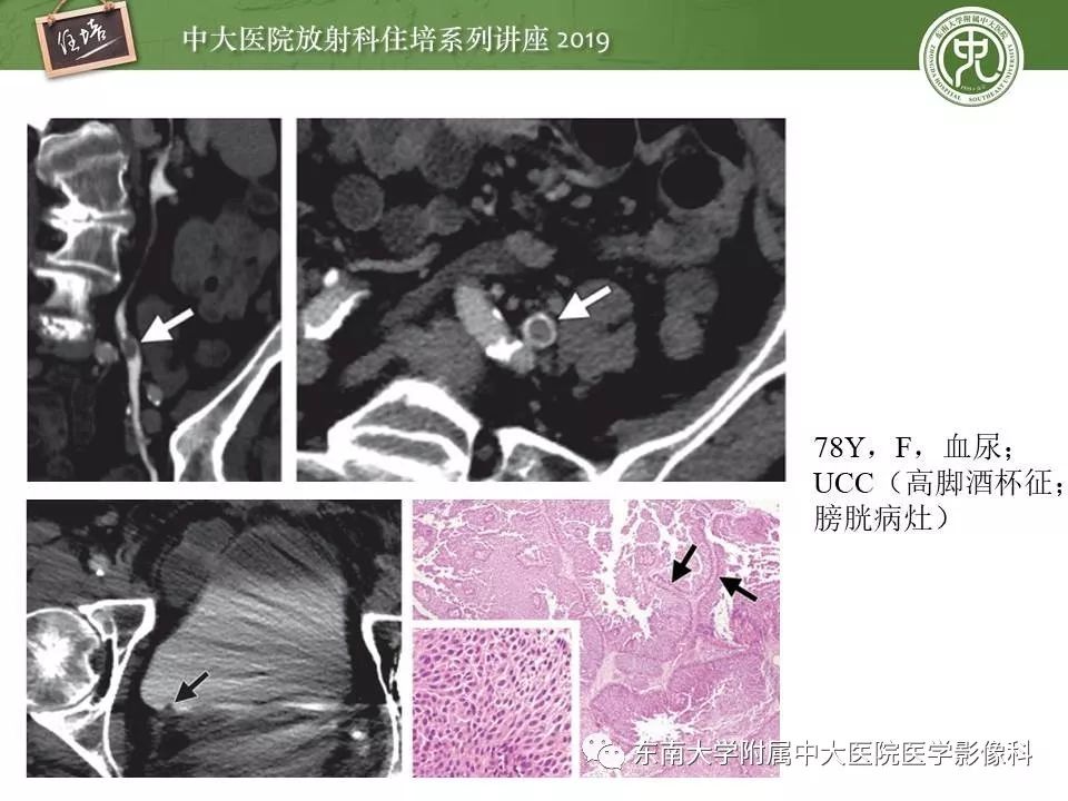 【PPT】血尿的影像分析思路