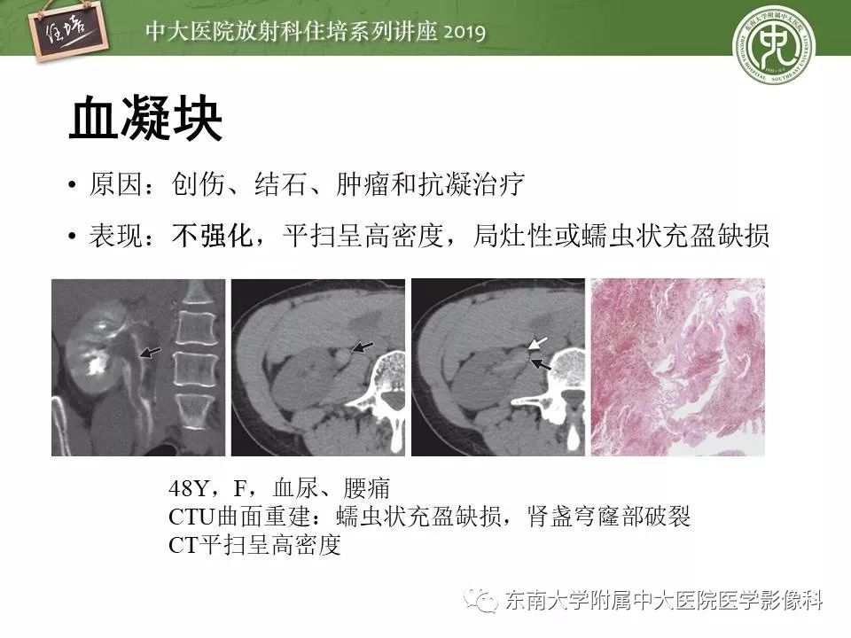 【PPT】血尿的影像分析思路