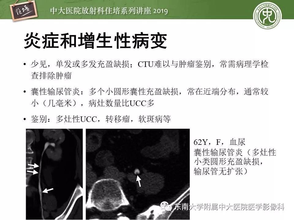 【PPT】血尿的影像分析思路