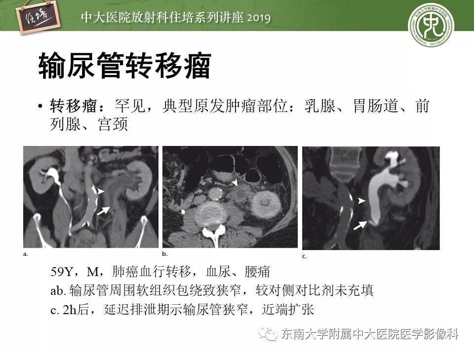 【PPT】血尿的影像分析思路
