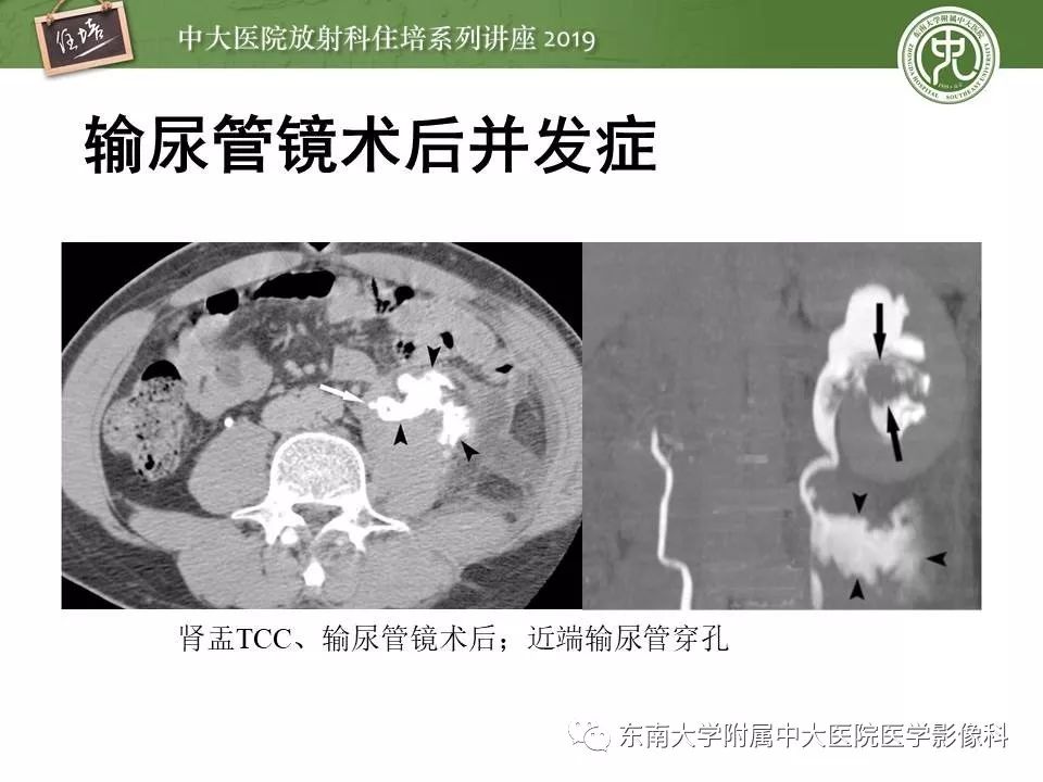 【PPT】血尿的影像分析思路