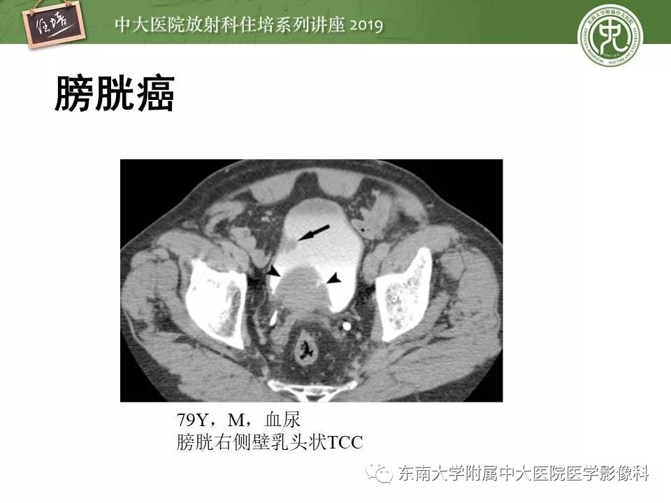 【PPT】血尿的影像分析思路