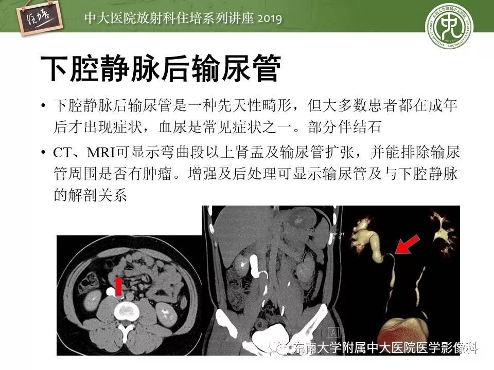 【PPT】血尿的影像分析思路