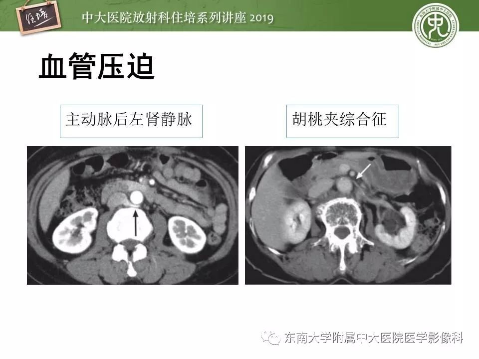 【PPT】血尿的影像分析思路