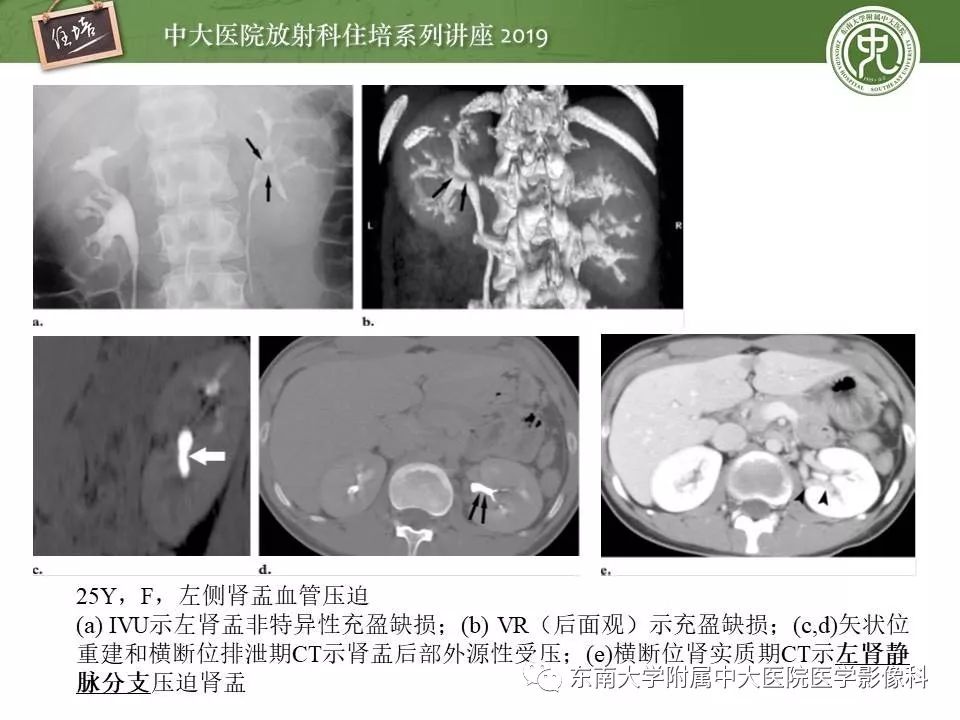 【PPT】血尿的影像分析思路