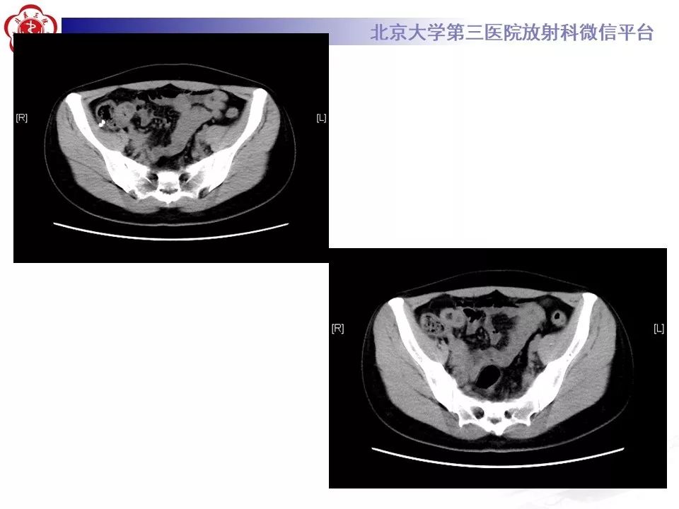 【病例】回肠重复畸形1例CT影像