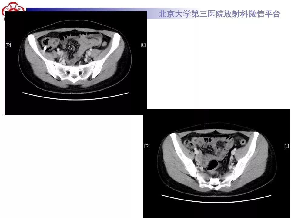 【病例】回肠重复畸形1例CT影像