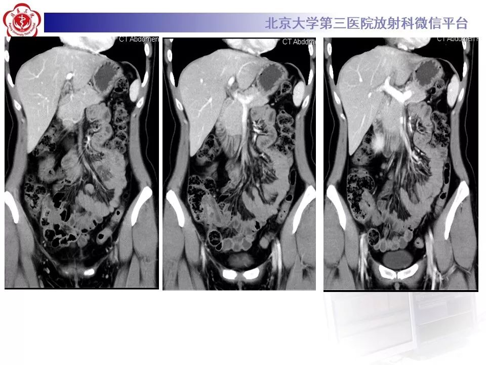 【病例】回肠重复畸形1例CT影像
