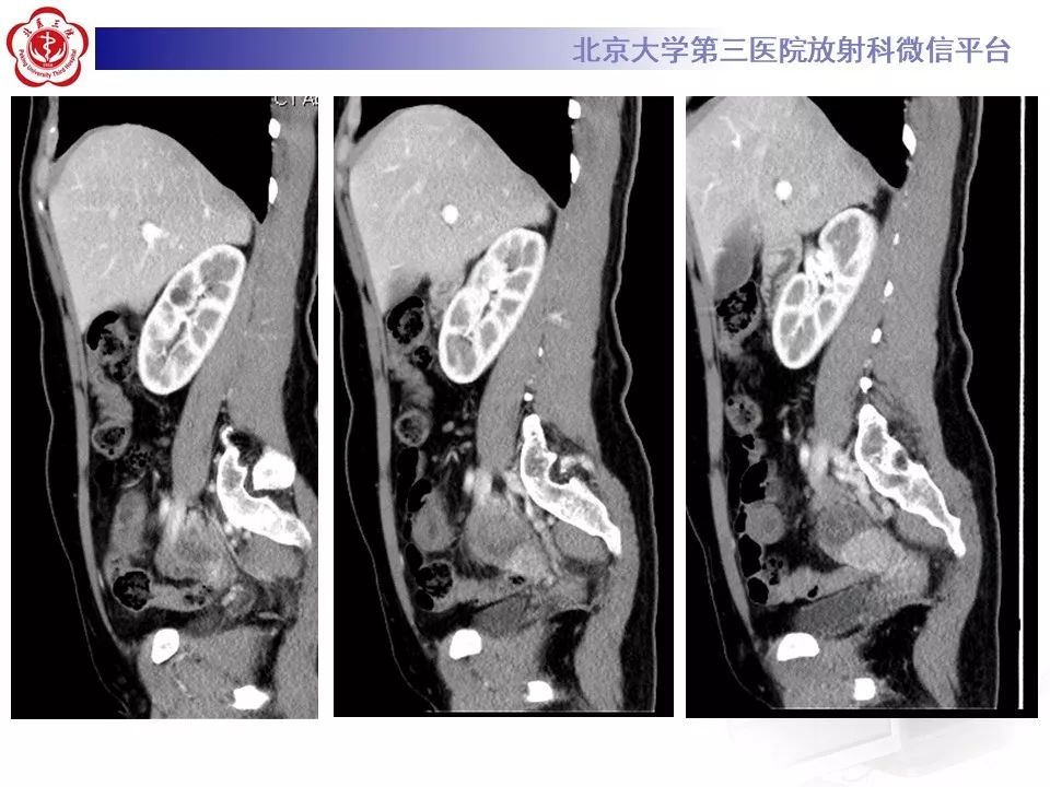 【病例】回肠重复畸形1例CT影像