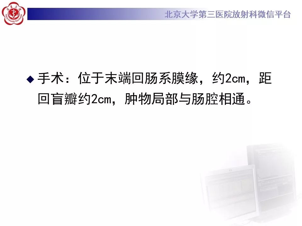 【病例】回肠重复畸形1例CT影像