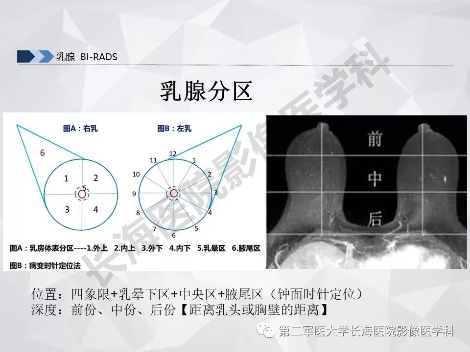 【PPT】乳腺MR规范检查及诊断
