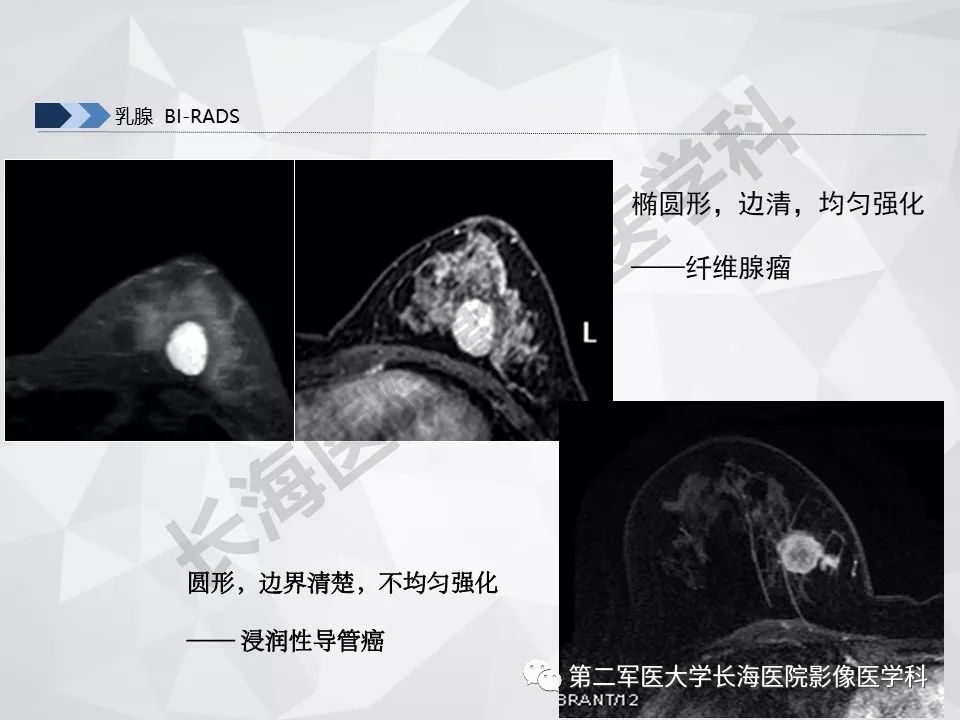 【PPT】乳腺MR规范检查及诊断
