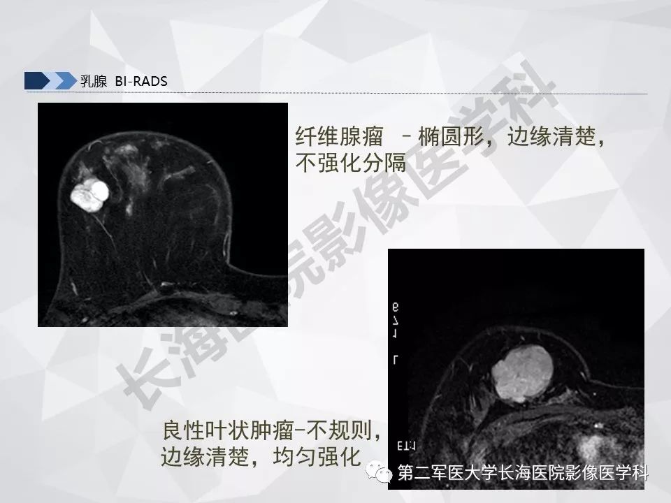 【PPT】乳腺MR规范检查及诊断