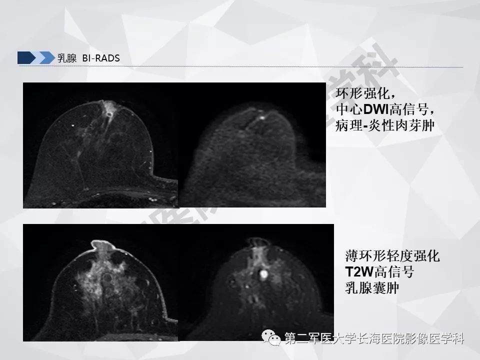 【PPT】乳腺MR规范检查及诊断