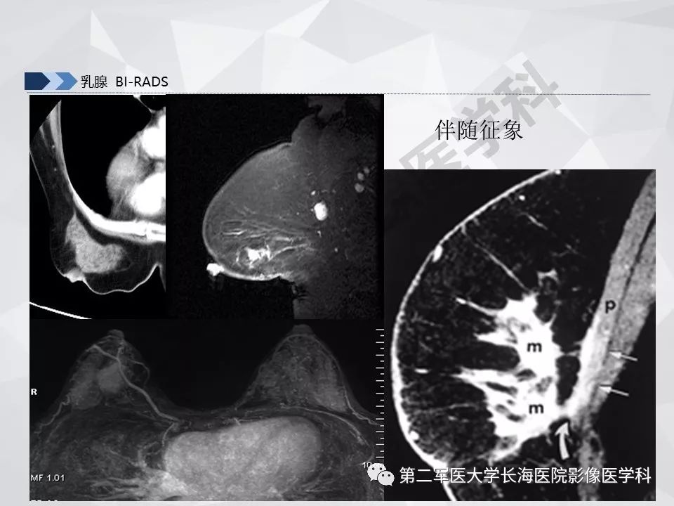 【PPT】乳腺MR规范检查及诊断