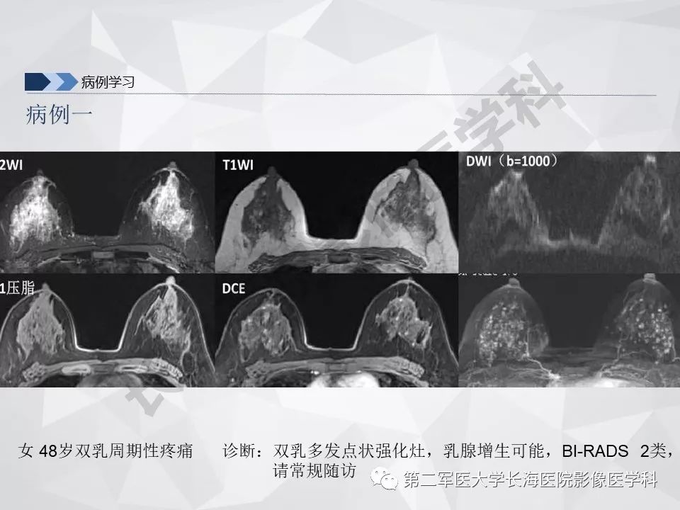 【PPT】乳腺MR规范检查及诊断