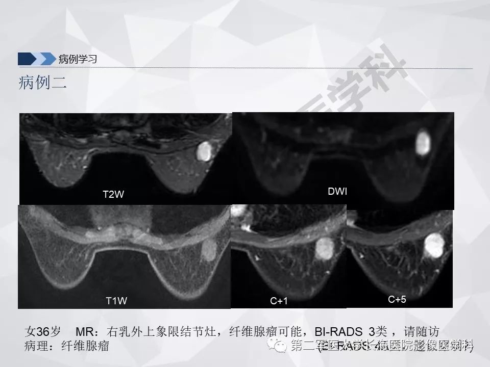 【PPT】乳腺MR规范检查及诊断