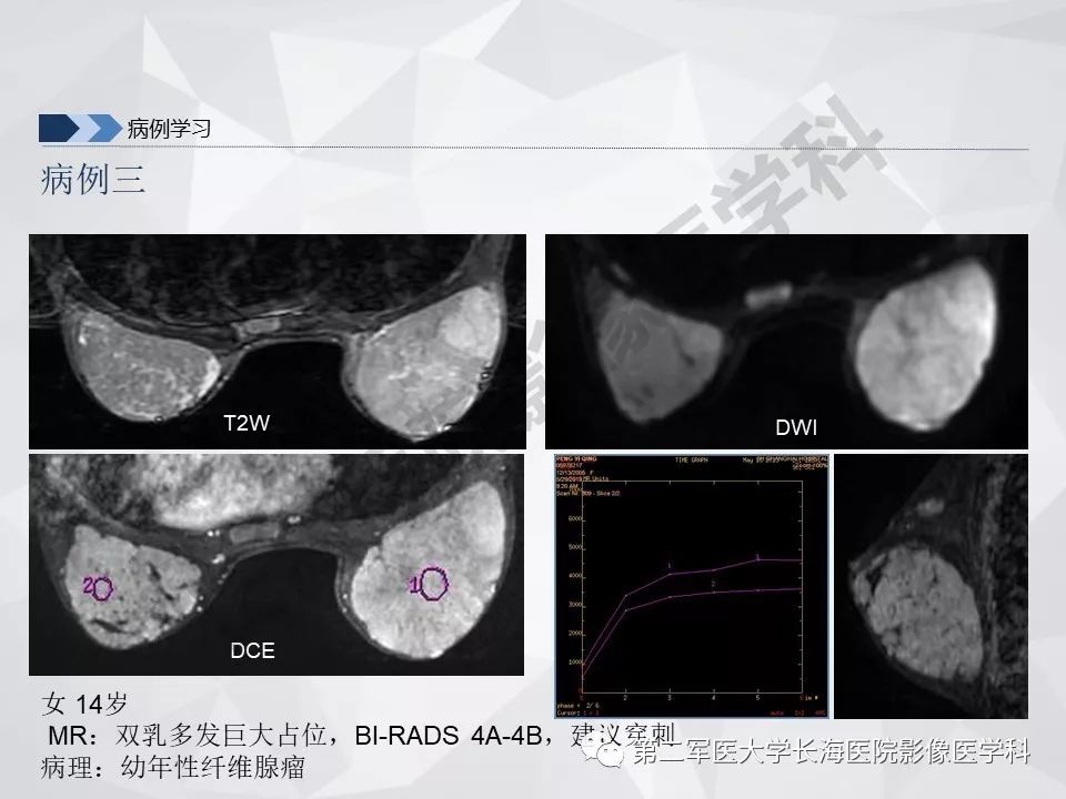 【PPT】乳腺MR规范检查及诊断