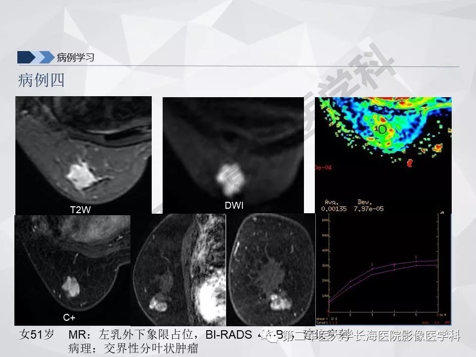 【PPT】乳腺MR规范检查及诊断