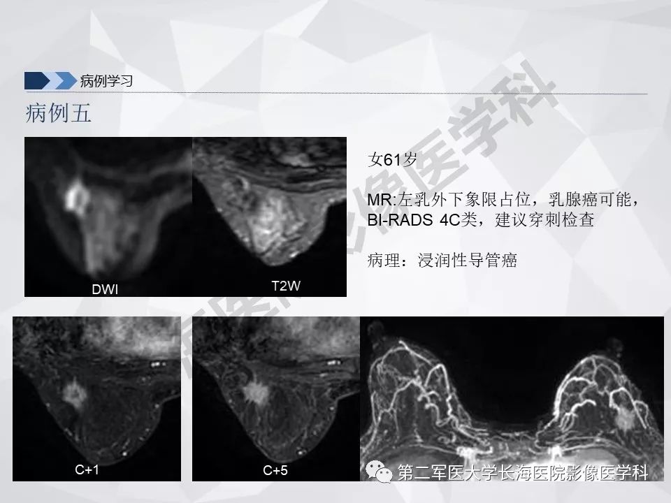 【PPT】乳腺MR规范检查及诊断