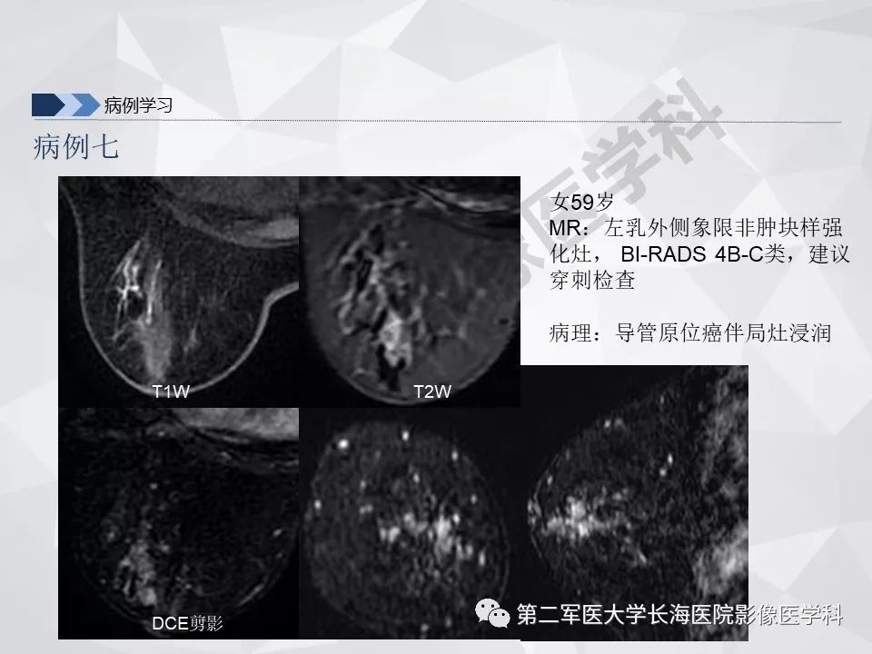 【PPT】乳腺MR规范检查及诊断