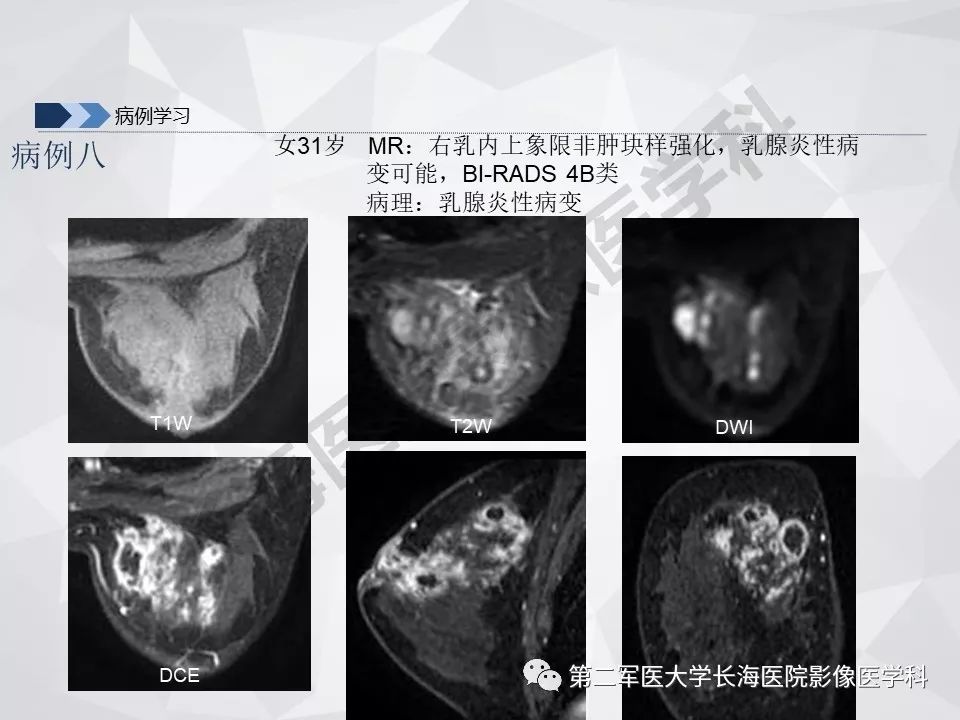 【PPT】乳腺MR规范检查及诊断