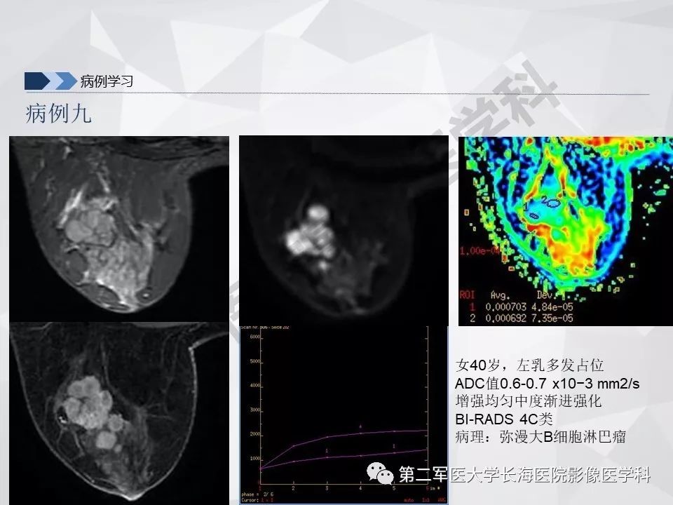 【PPT】乳腺MR规范检查及诊断
