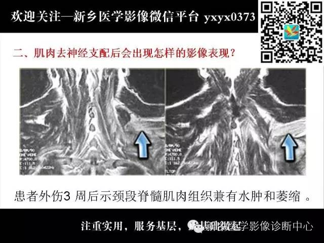【PPT】肌肉去神经支配的影像表现