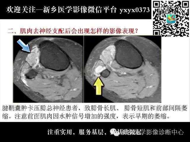 【PPT】肌肉去神经支配的影像表现
