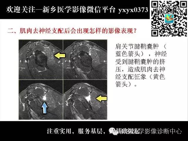 【PPT】肌肉去神经支配的影像表现