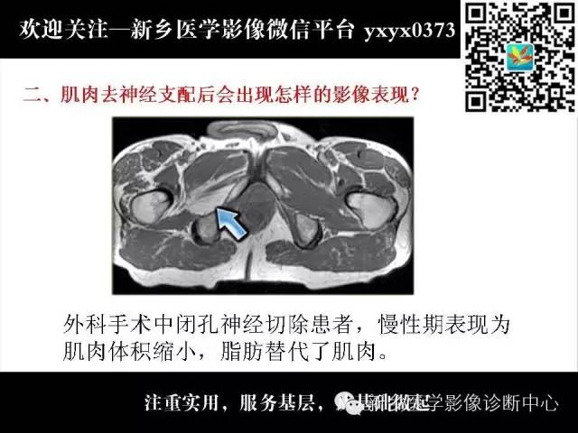 【PPT】肌肉去神经支配的影像表现