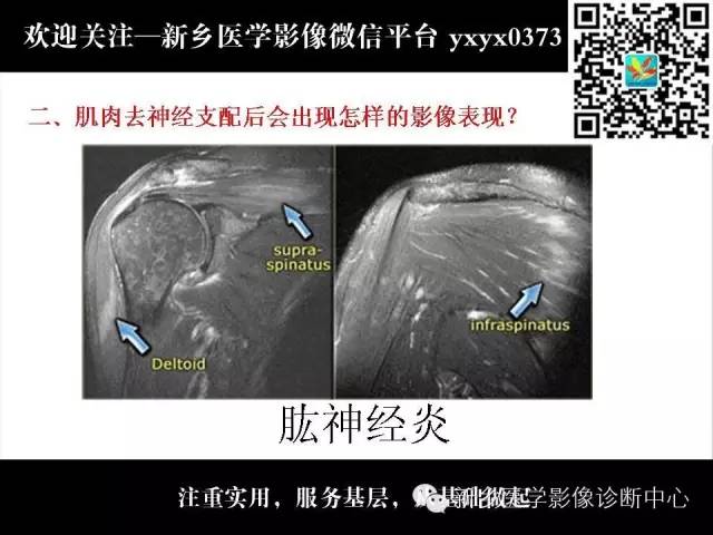 【PPT】肌肉去神经支配的影像表现
