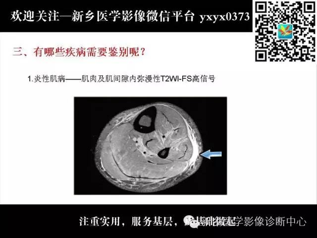 【PPT】肌肉去神经支配的影像表现