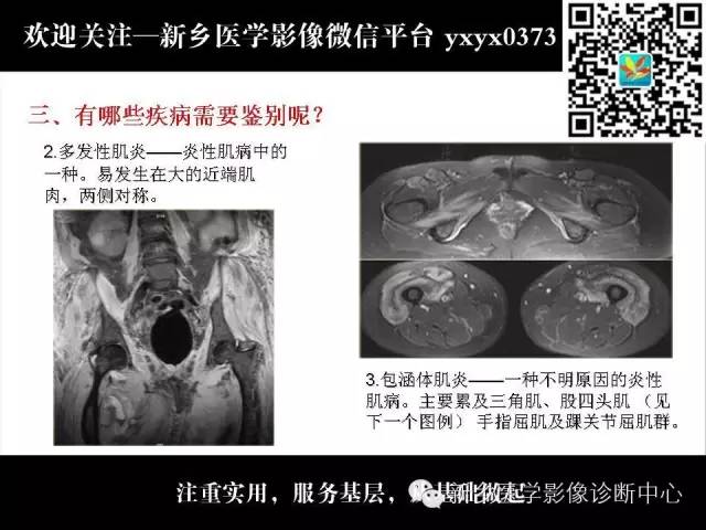 【PPT】肌肉去神经支配的影像表现