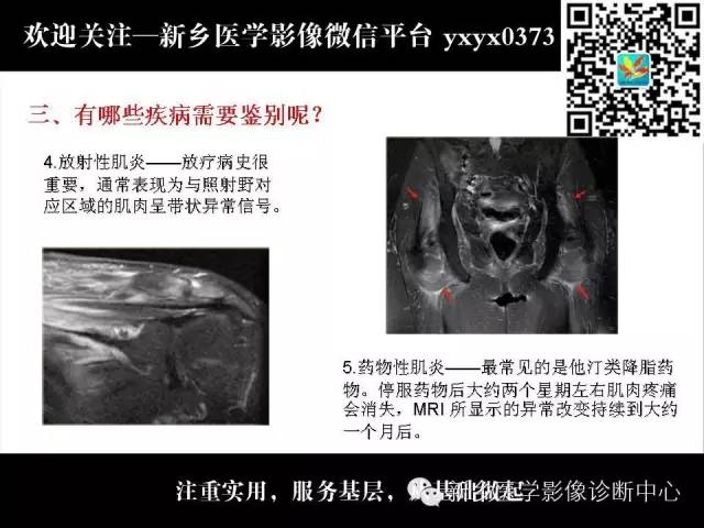 【PPT】肌肉去神经支配的影像表现