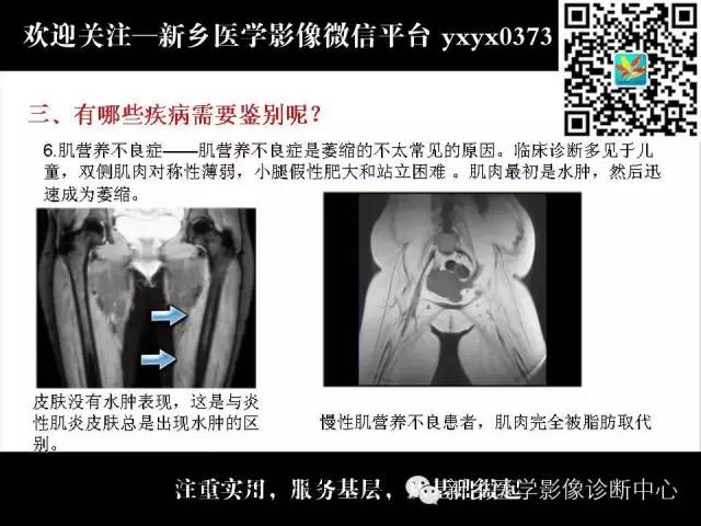 【PPT】肌肉去神经支配的影像表现