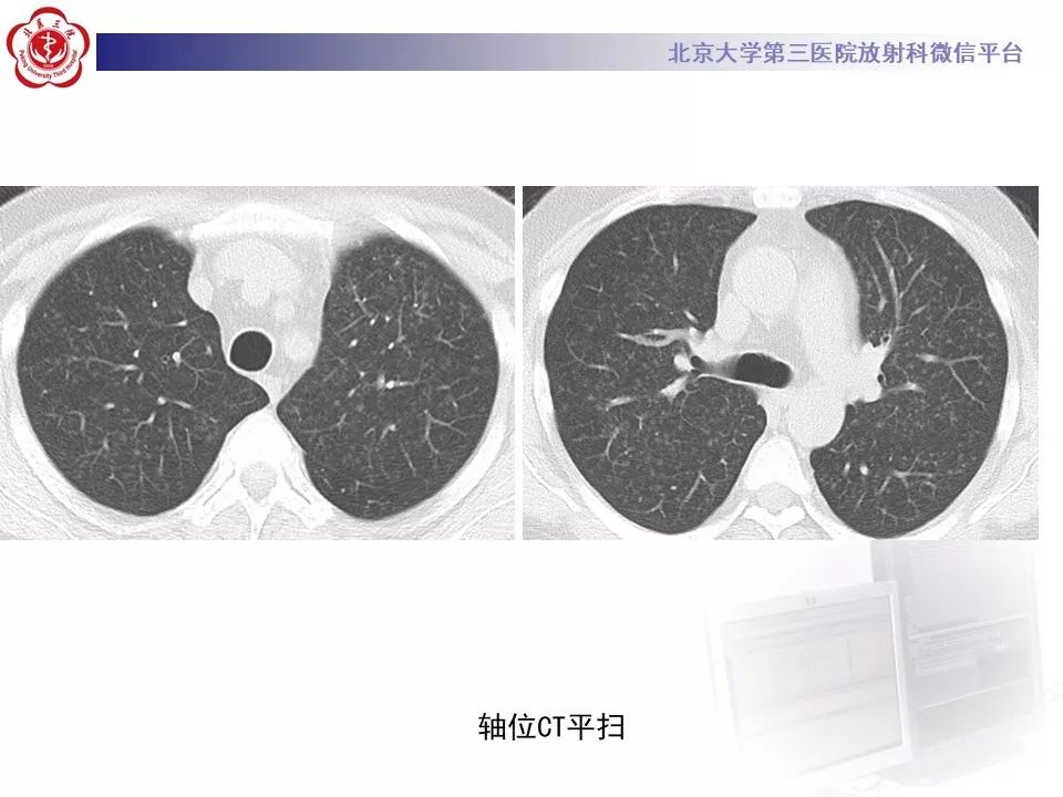 【病例】巨细胞病毒性肺炎1例CT影像