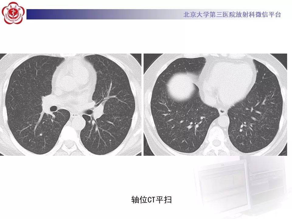 【病例】巨细胞病毒性肺炎1例CT影像