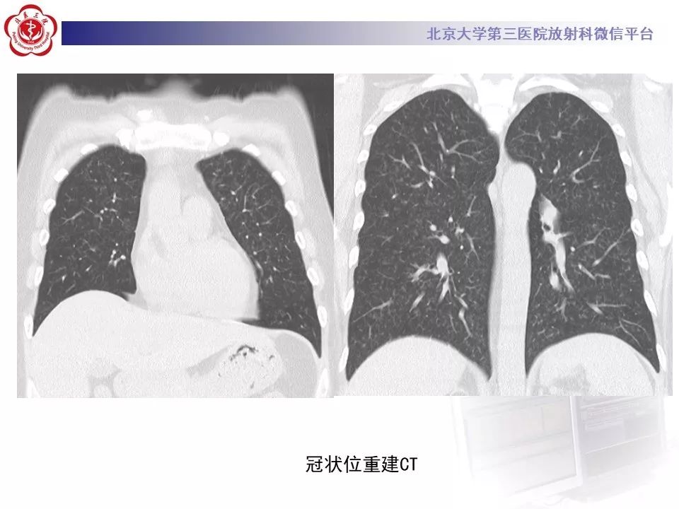 【病例】巨细胞病毒性肺炎1例CT影像