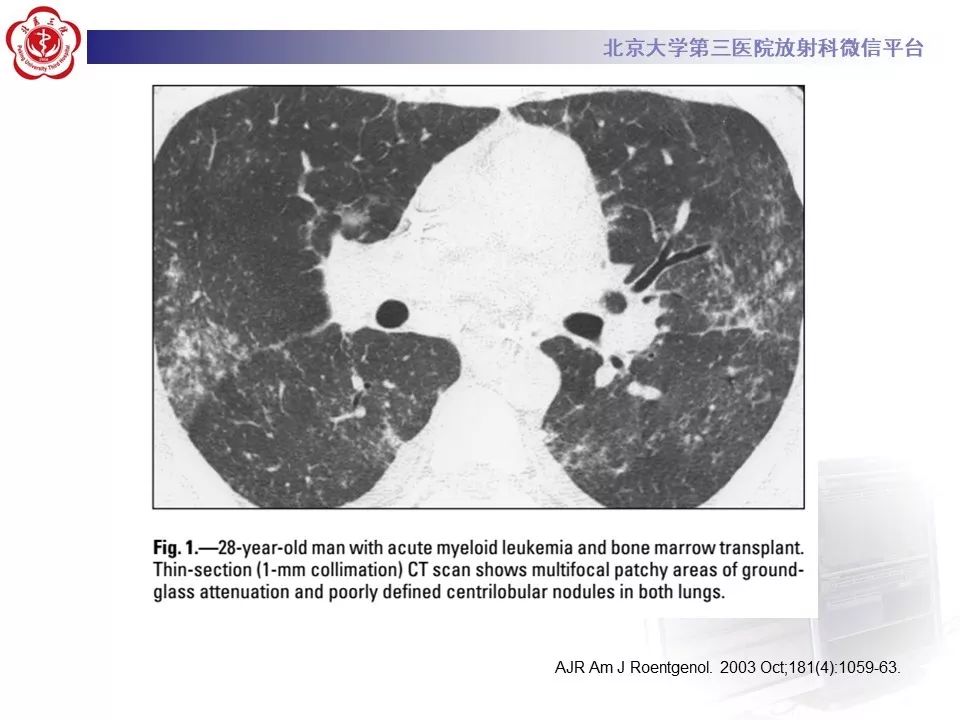 【病例】巨细胞病毒性肺炎1例CT影像