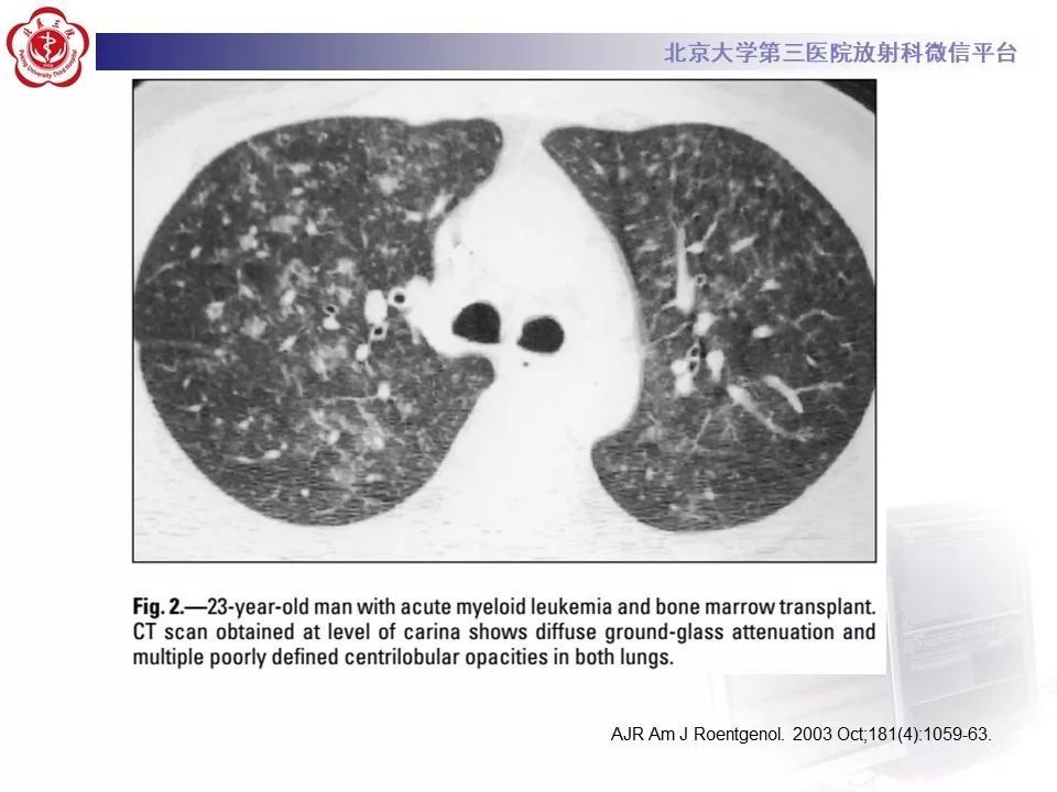 【病例】巨细胞病毒性肺炎1例CT影像