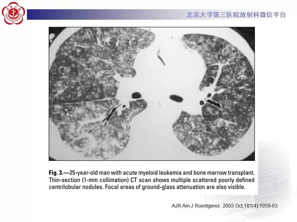 【病例】巨细胞病毒性肺炎1例CT影像