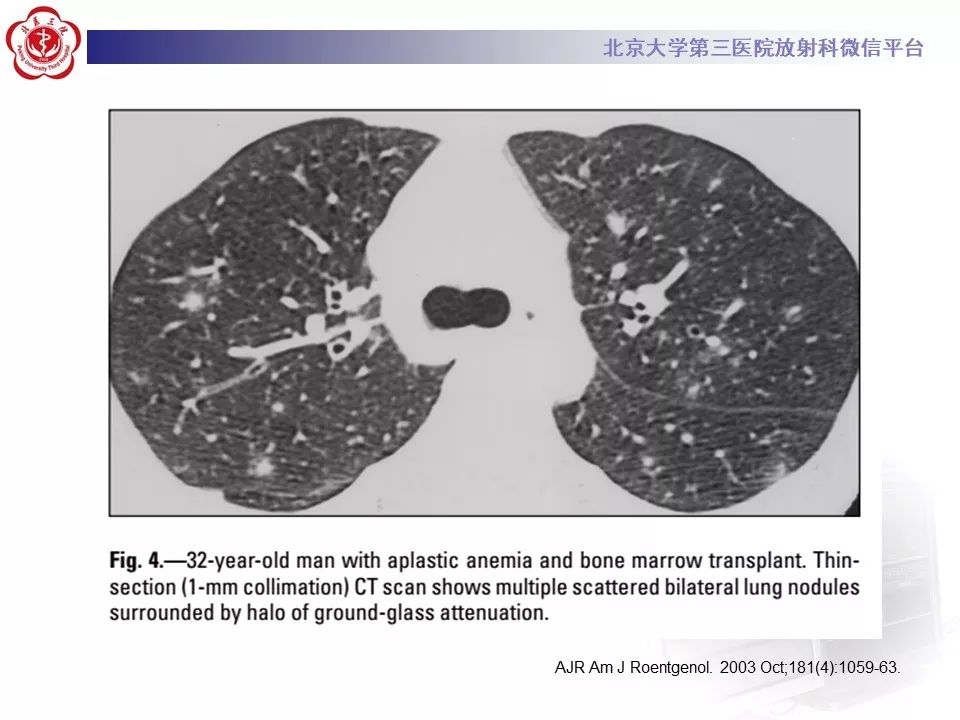 【病例】巨细胞病毒性肺炎1例CT影像